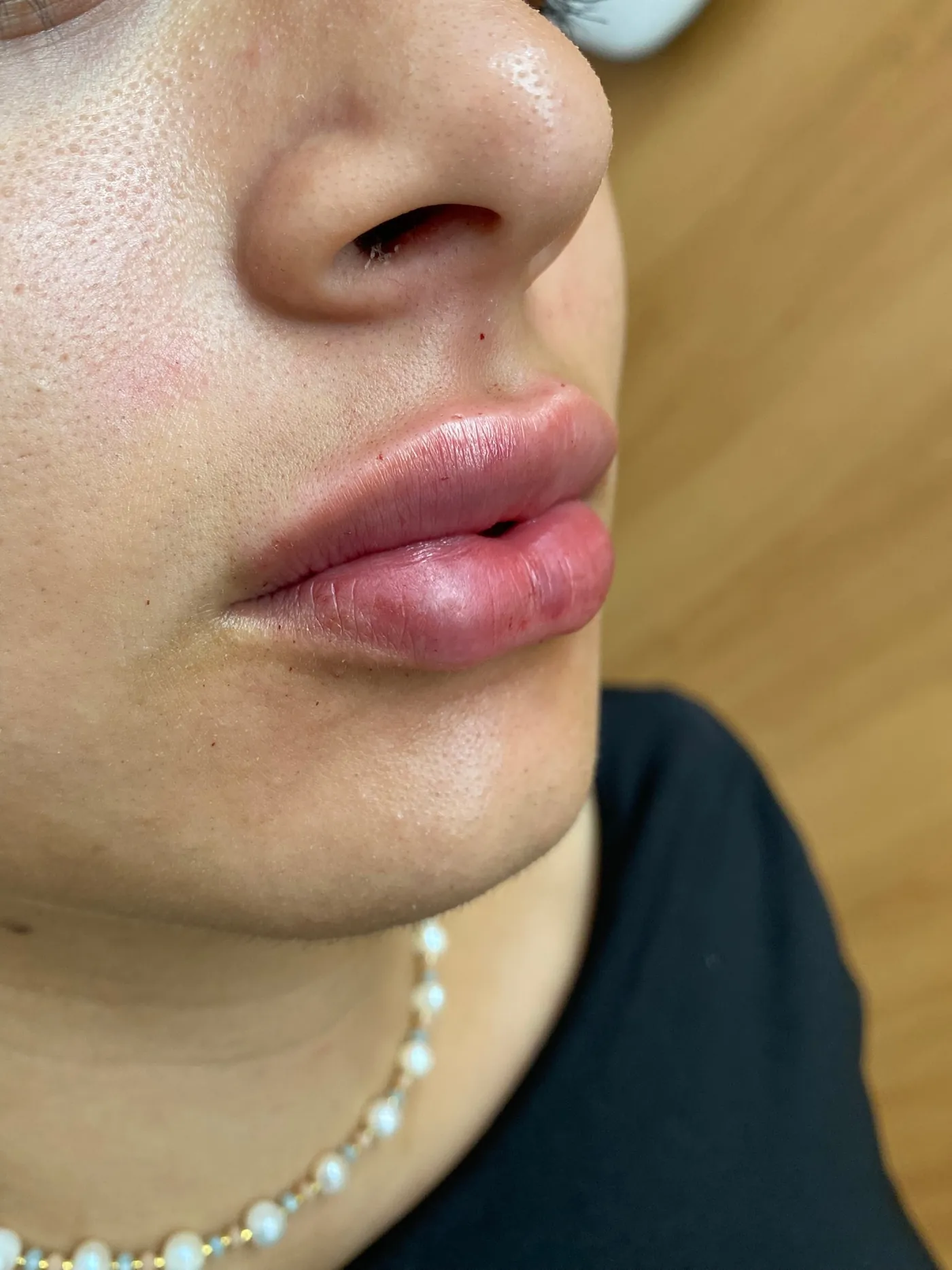 Antes e depois — preenchimento labial