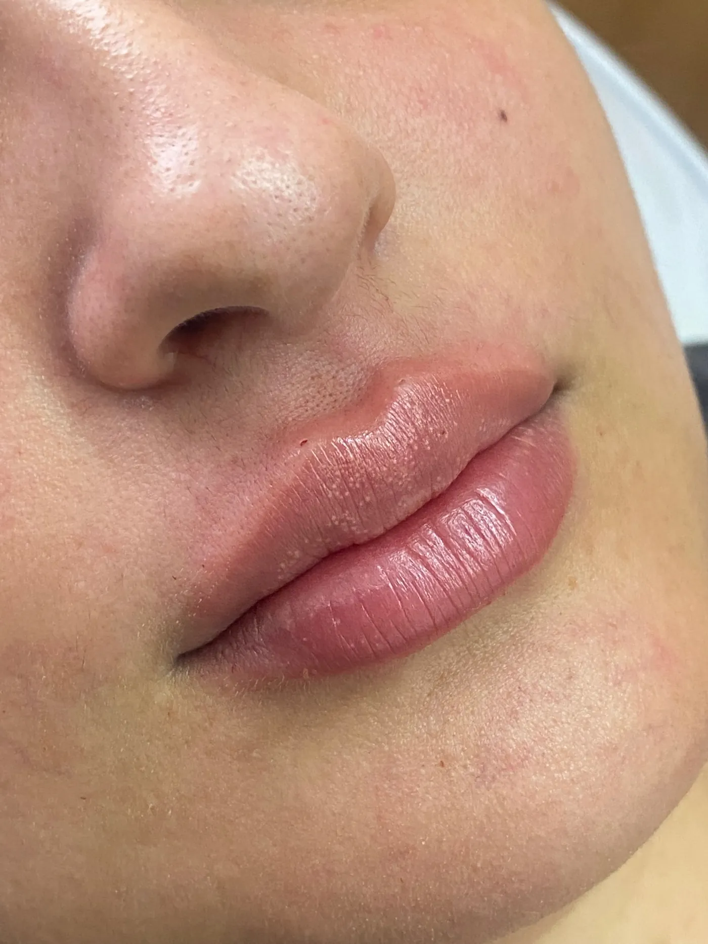 Preenchimento labial