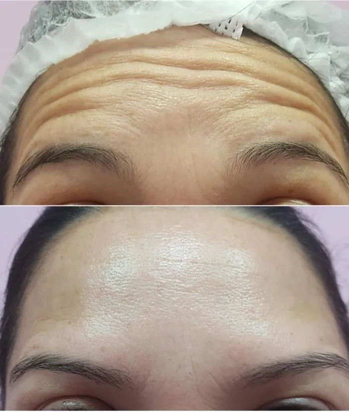 Antes e depois — linhas da testa