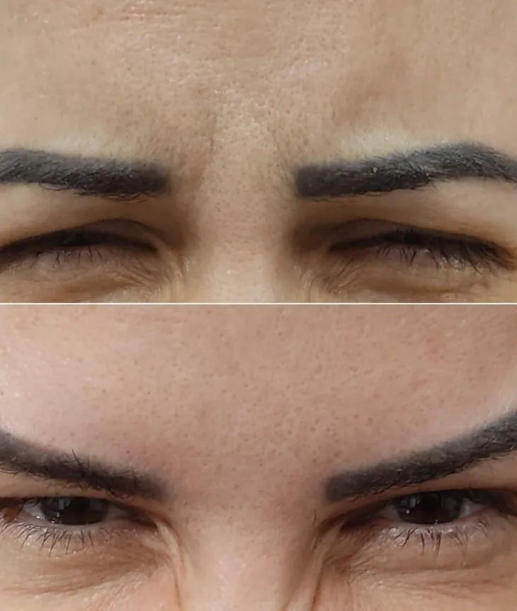 Antes e depois — linhas de expressão